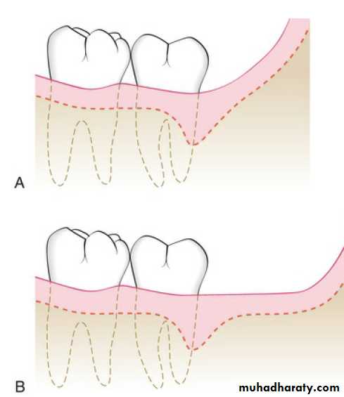 flap surgery
