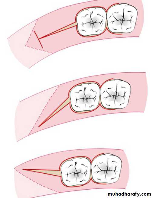 flap surgery