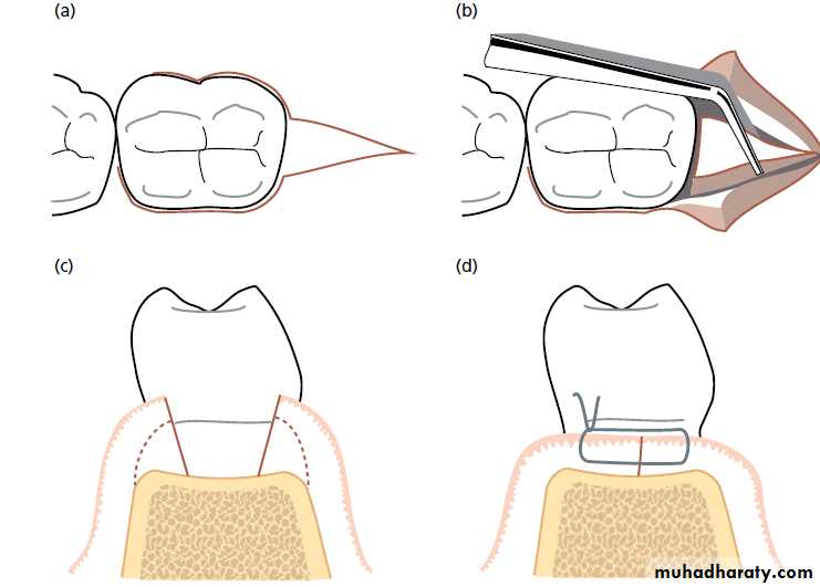 flap surgery