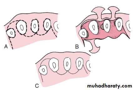 flap surgery