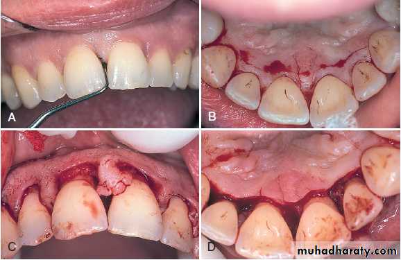 flap surgery