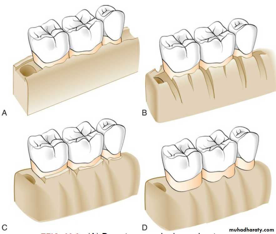flap surgery