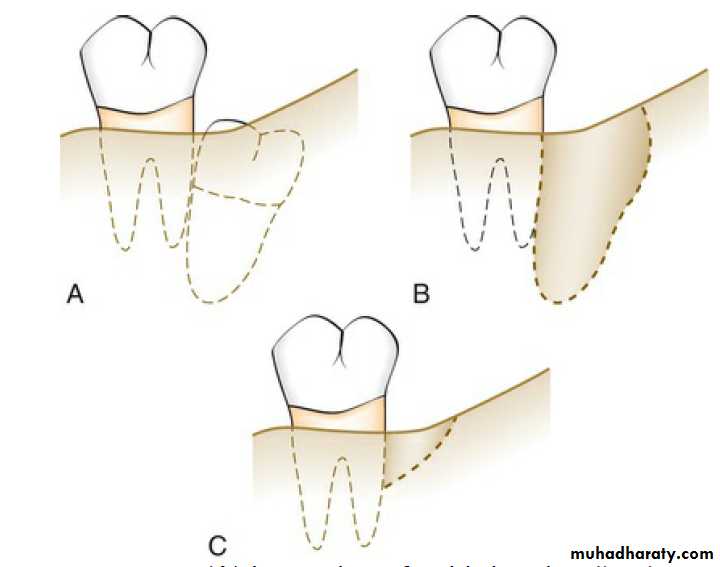 flap surgery