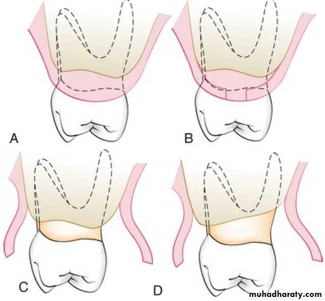 flap surgery