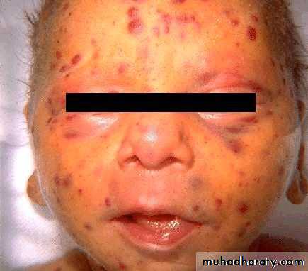 Rubella and Congenital Viral Infections