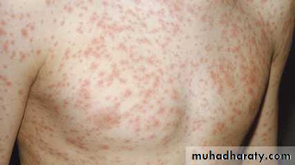 Rubella and Congenital Viral Infections