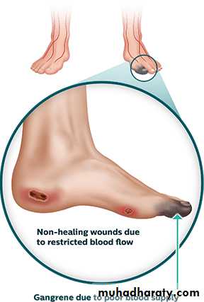 Chronic Limb Ischemia