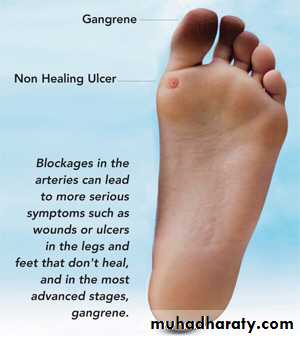 Chronic Limb Ischemia