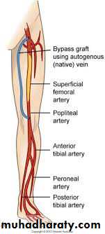 Chronic Limb Ischemia