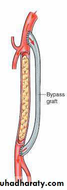 Chronic Limb Ischemia