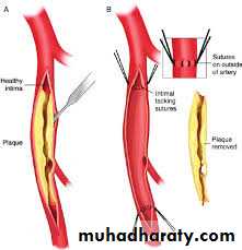 Chronic Limb Ischemia