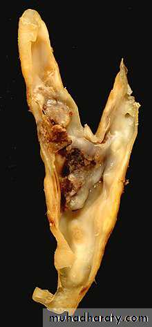 Chronic Limb Ischemia