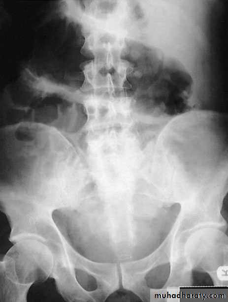 Small and large Bowel