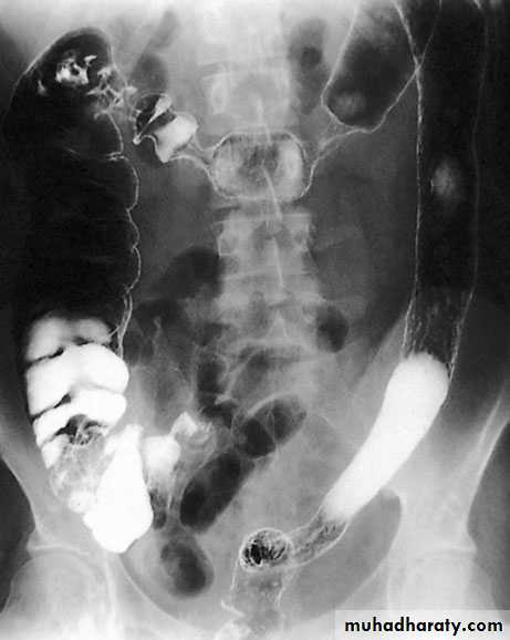 Small and large Bowel