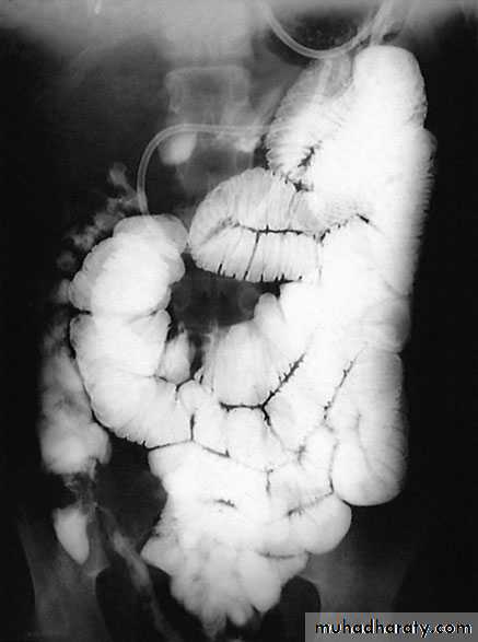 Small and large Bowel