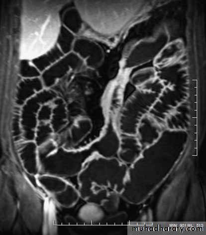 Small and large Bowel