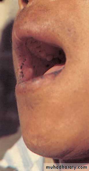 Small and large Bowel