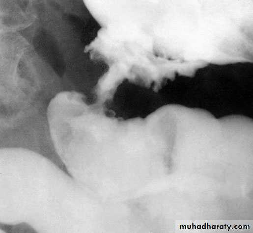 Small and large Bowel