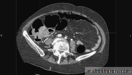 Small and large Bowel