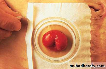 Small and large Bowel