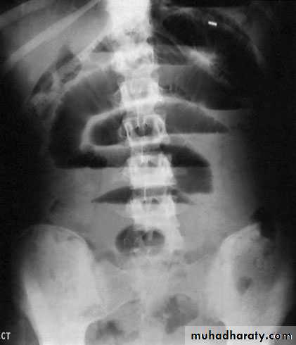 Small and large Bowel