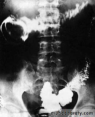 Small and large Bowel