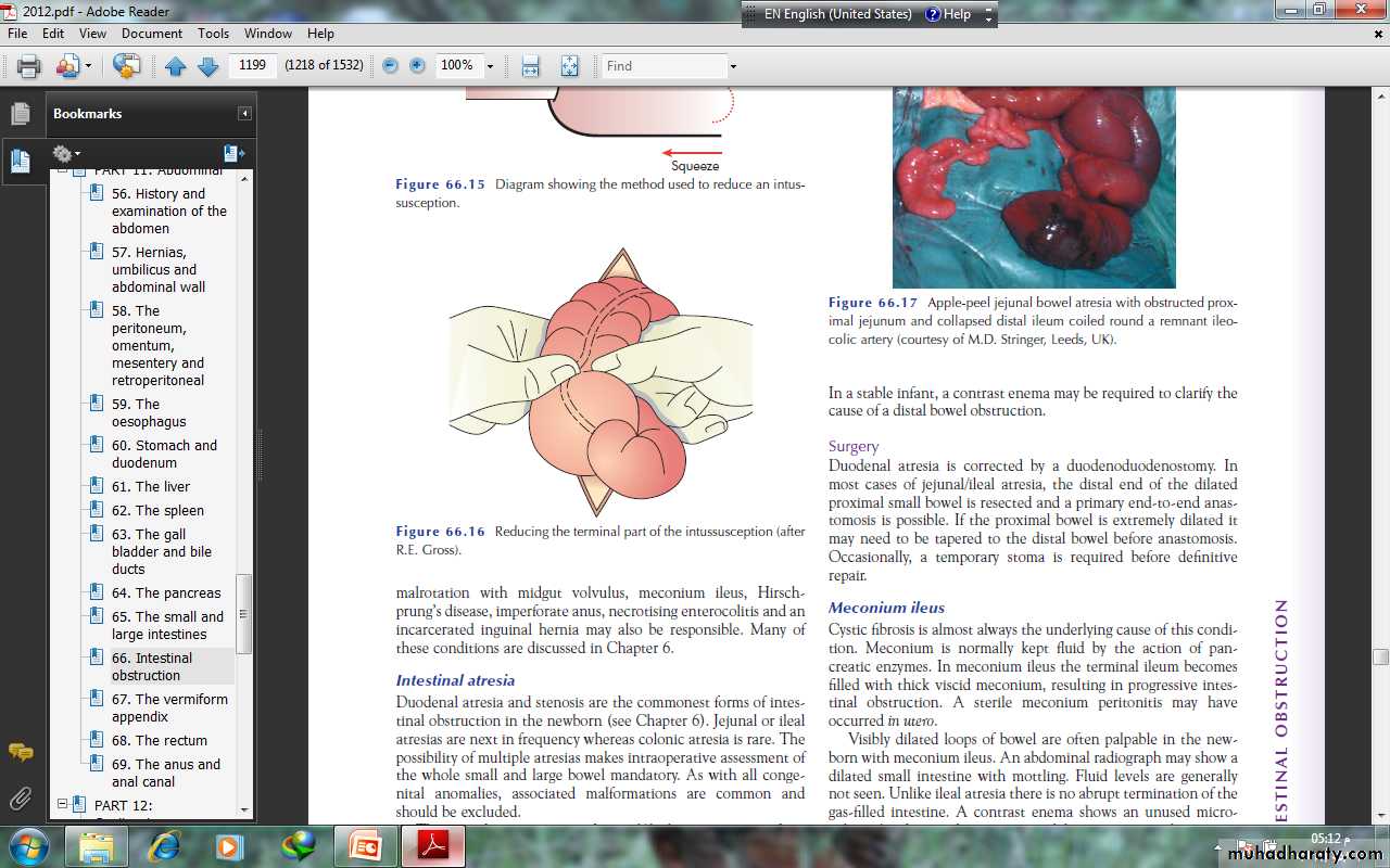 Small and large Bowel