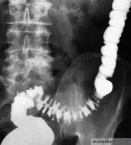 Small and large Bowel