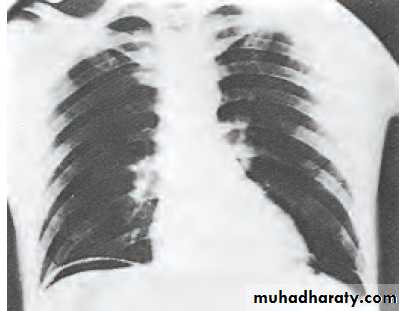 Complications of Peptic Ulceration