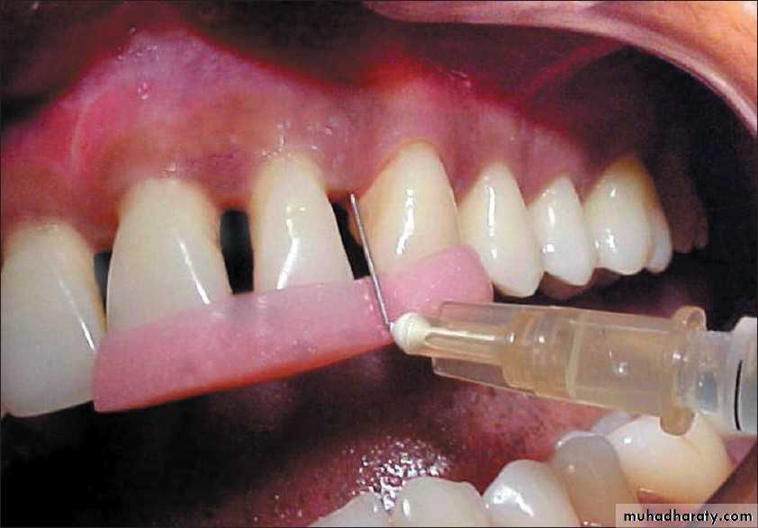 medicaments for periodontal diseases
