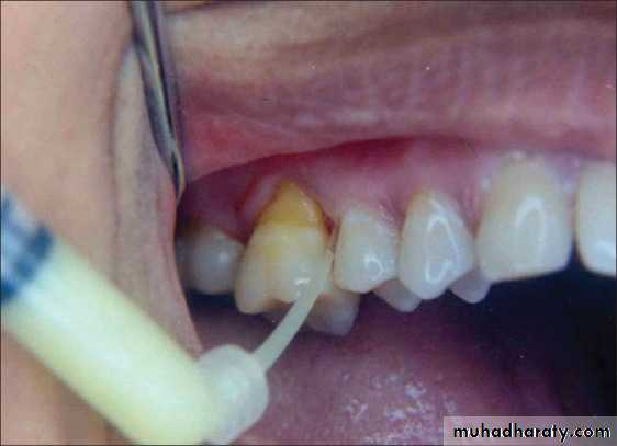 medicaments for periodontal diseases