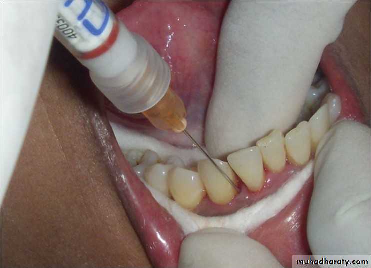 medicaments for periodontal diseases