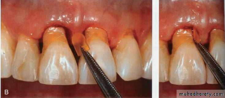 medicaments for periodontal diseases