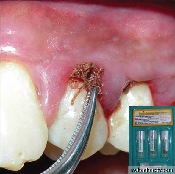 medicaments for periodontal diseases