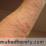 Anaphylaxis