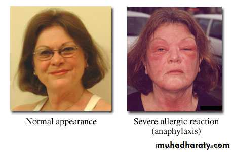 Anaphylaxis