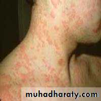 Anaphylaxis