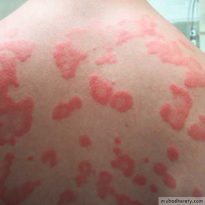 Anaphylaxis
