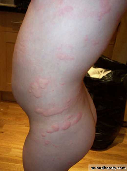 Anaphylaxis