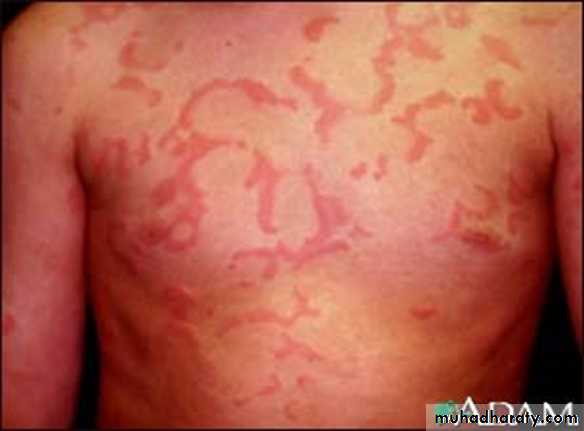 Anaphylaxis