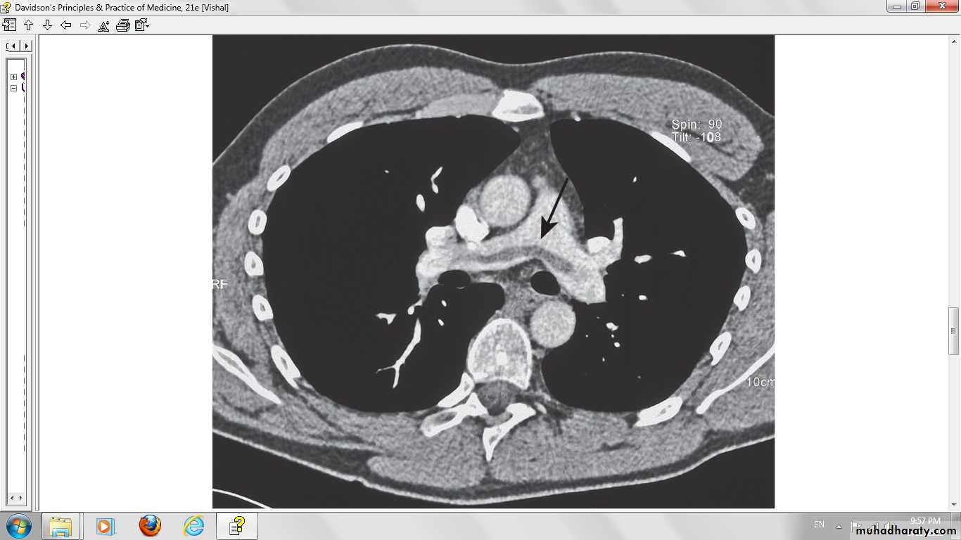 Pulmonary vascular disease