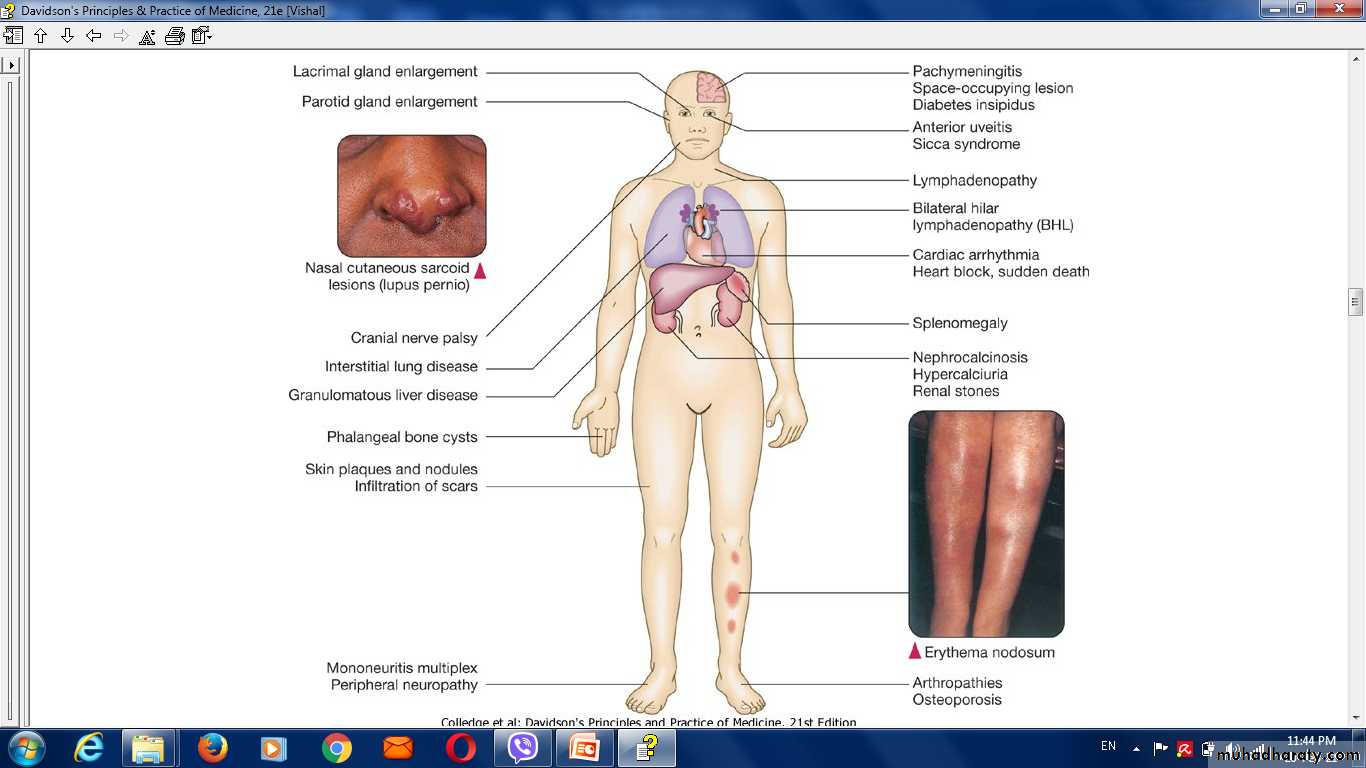 ILD