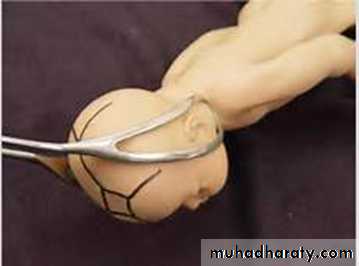 Instrumental Delivery