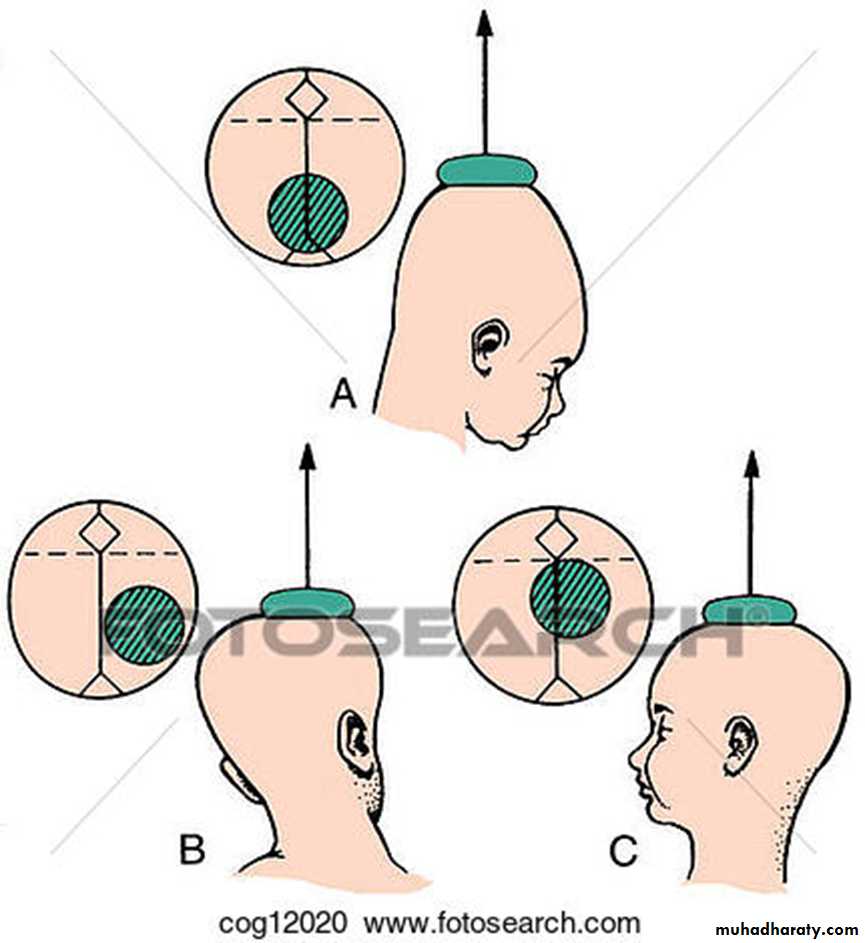 Instrumental Delivery