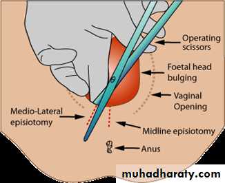Instrumental Delivery