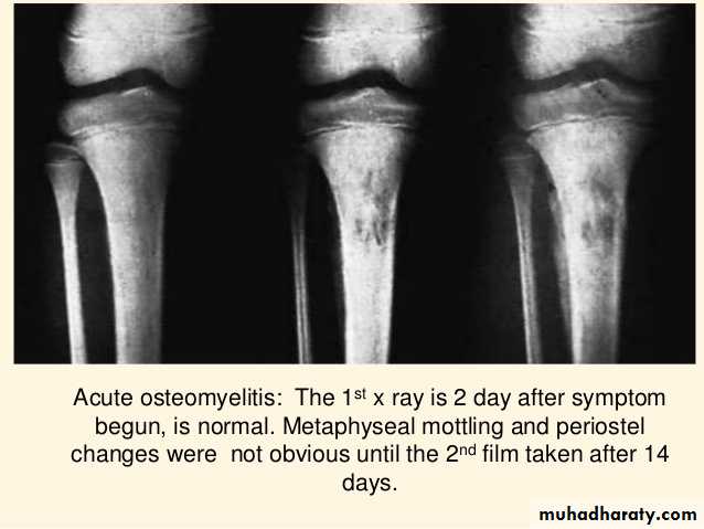 Osteomyelitis