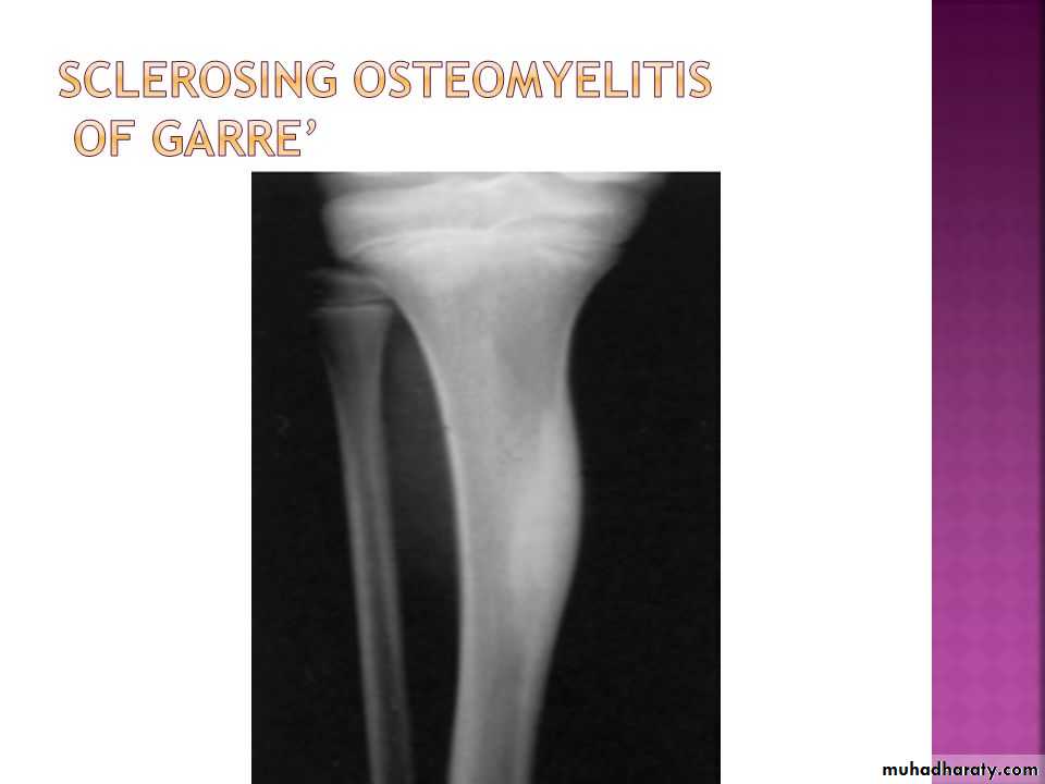 Osteomyelitis