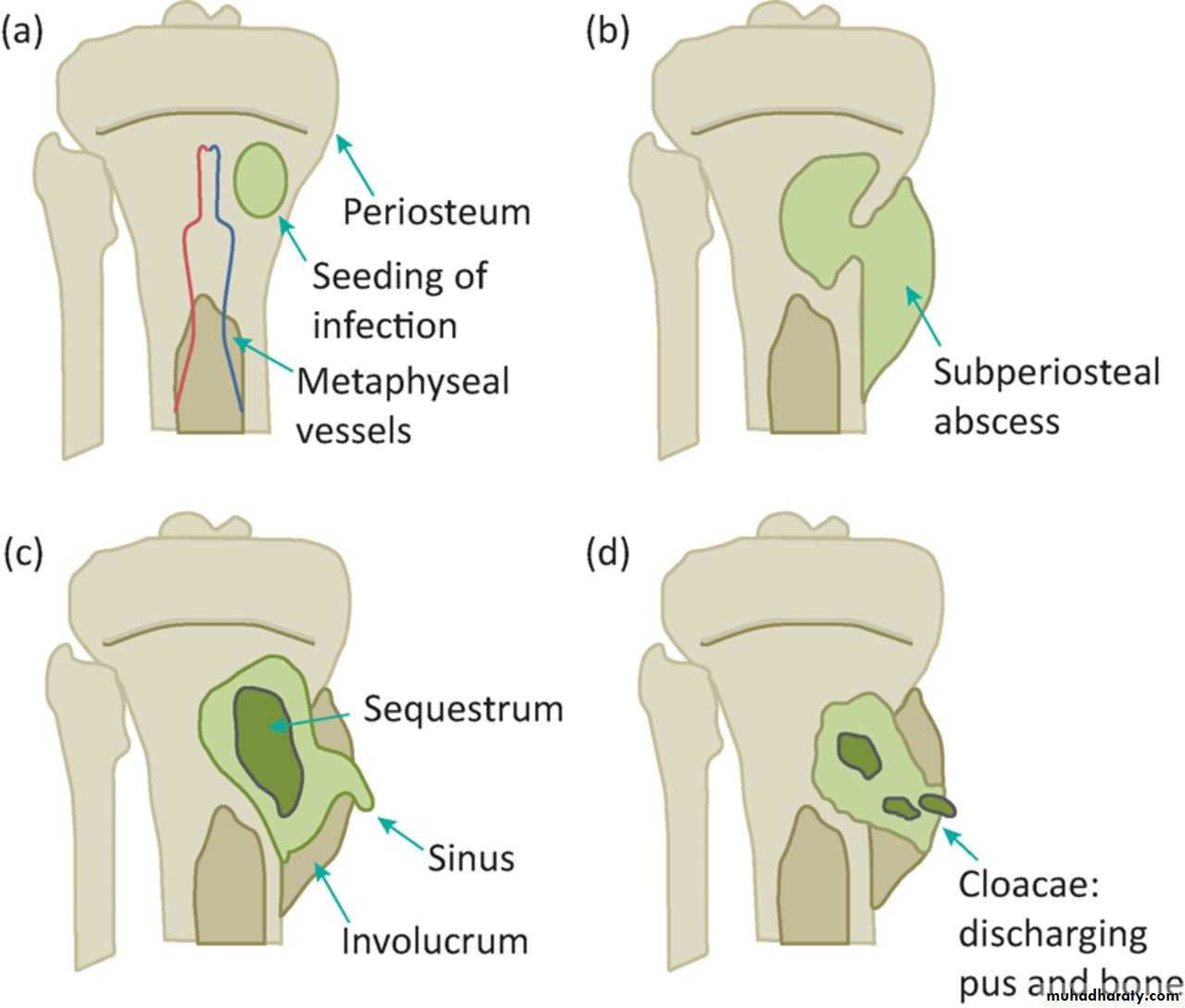 Osteomyelitis