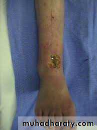 Osteomyelitis