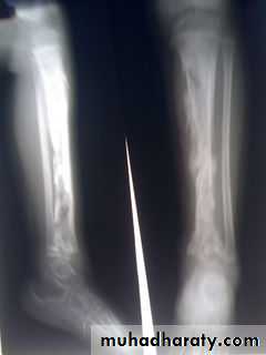 Osteomyelitis